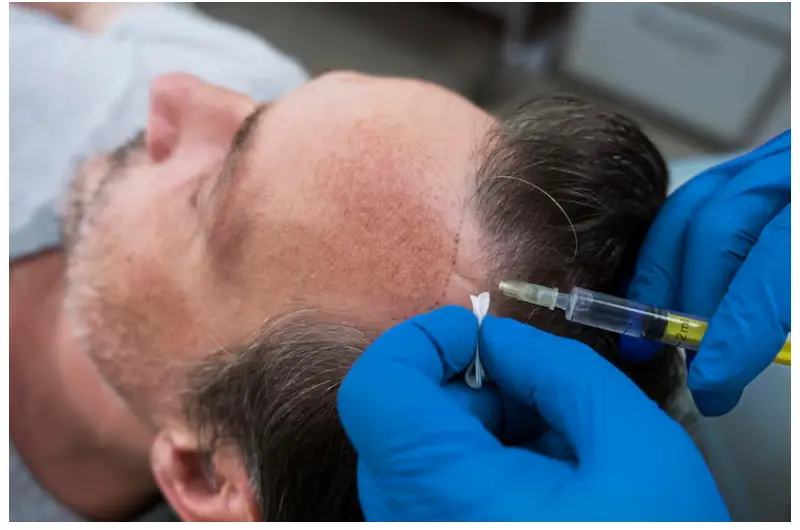 unshaven hair transplant in istanbul