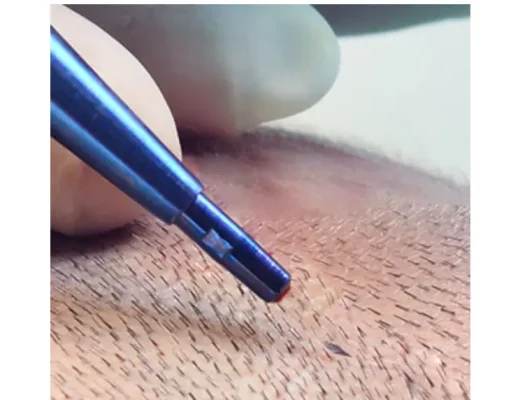 Beard transplant in Istanbul