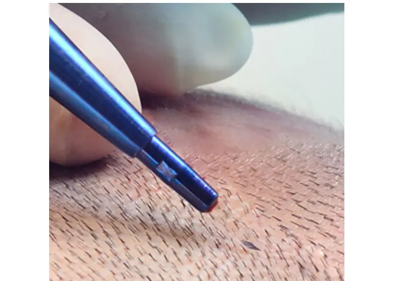 Beard transplant in Istanbul